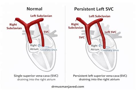 Persistent Left Superior Vena Cava