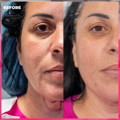 Pet Lift Face Surgery Cost