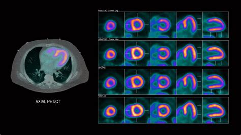 Pet Scan For Heart