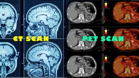 Pet Scan Vs Ct Scan