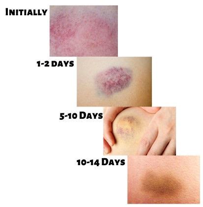 Phases Of Bruising