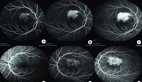 Phases Of Fluorescein Angiography