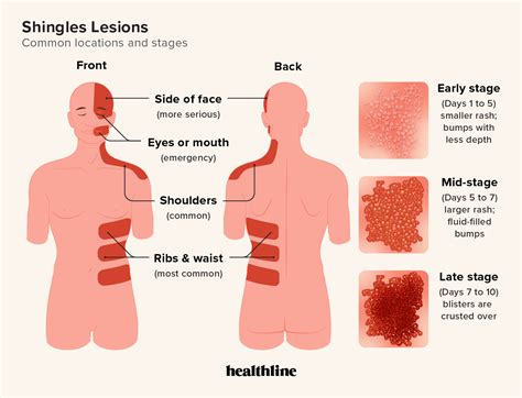 Phases Of Shingles
