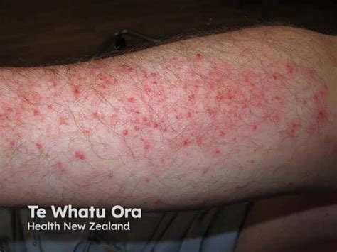 Photosensitivity Rash Photos
