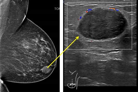 Phyllodes Tumor Breast
