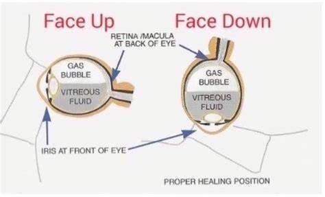 Pictures Of Face Down Position After Retinal Surgery