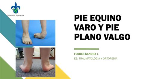 Pie Equino Varo
