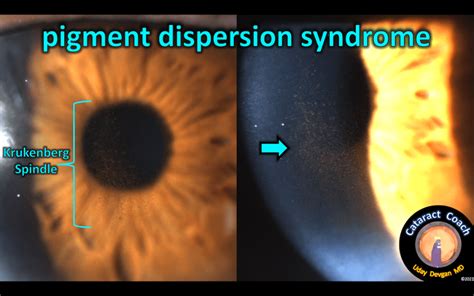 Pigment Dispersion Syndrome
