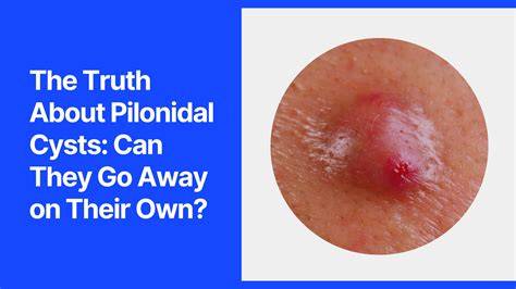 Pilonidal Sinus Popped