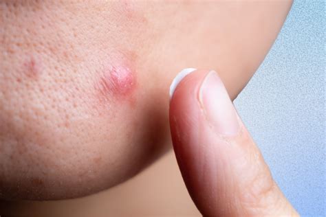 Pimple At Anus