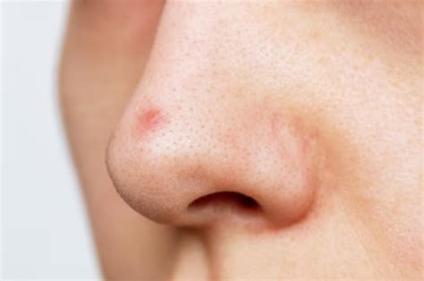 Pimple At Nose