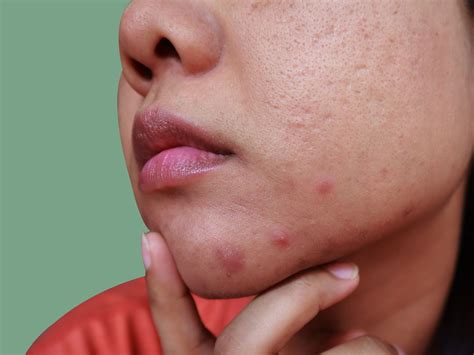 Pimple On Chin
