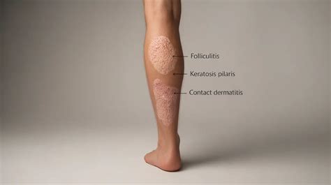 Pimple On Leg