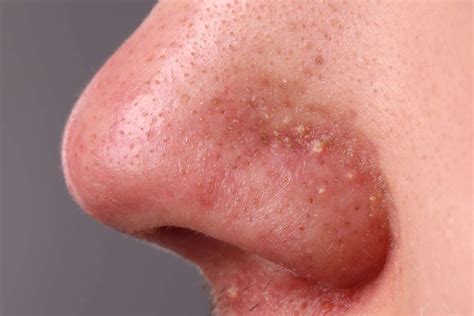 Pimple Up Nose
