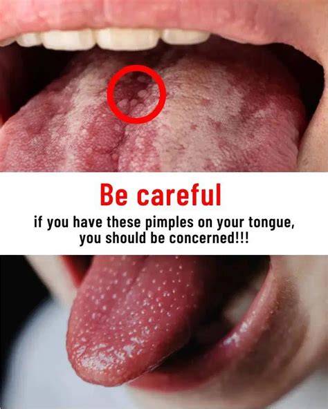 Pimples On A Tongue