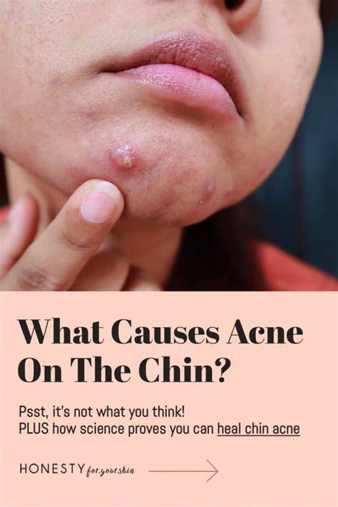 Pimples On Chin