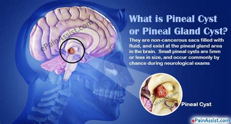 Pineal Gland Cyst