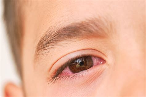 Pink Eye In Spanish