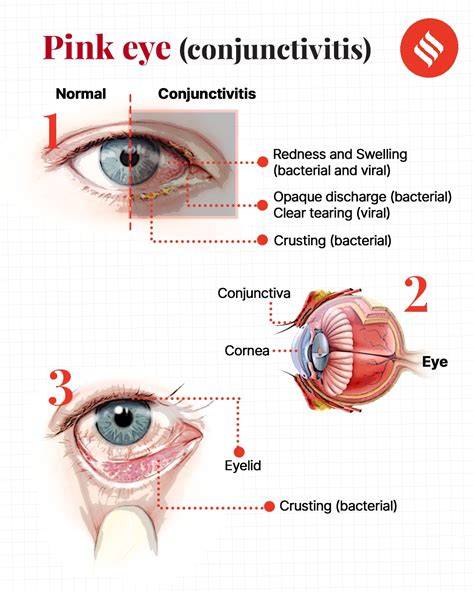 Pink Eye Incubation Period