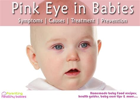 Pinkeye In Newborns