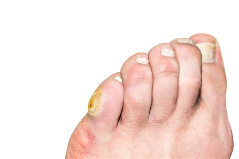Pinky Toe Corn Callus
