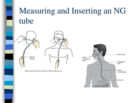 Placing Nasogastric Tube