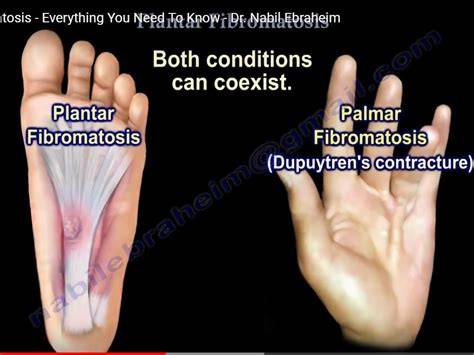 Plantar Fascia Fibromatosis