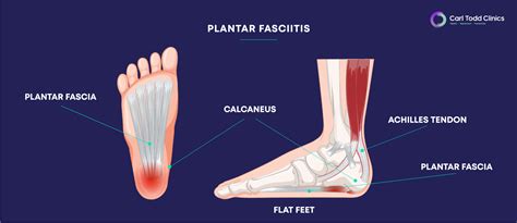 Plantar Fascia Vs Plantar Fasciitis