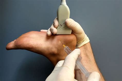 Plantar Fasciitis And Cortisone Shots