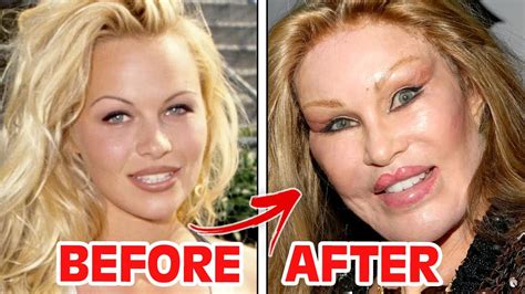 Plastic Surgery Face Before And After