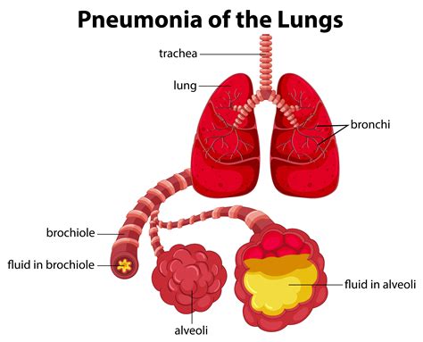 Pneumonia How Does It Affect Respiratory System