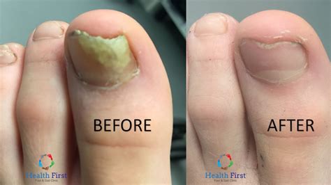 Podiatrist Nail Fungus