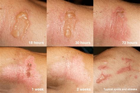 Poison Hemlock Rash