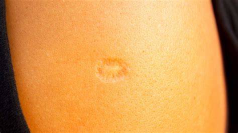 Polio Immunization Scar