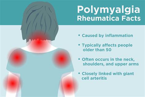 Polymyalgia Rheumatica Treatments