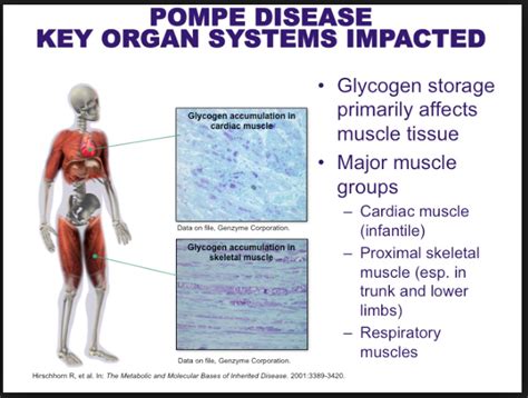 Pompe Disease Symptoms