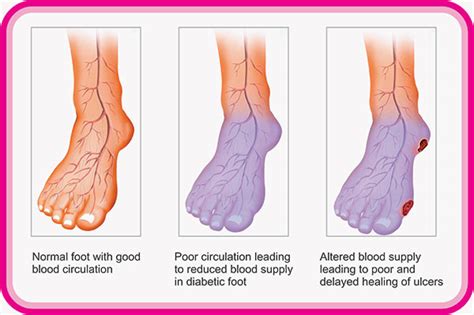 Poor Blood Circulation In Feet