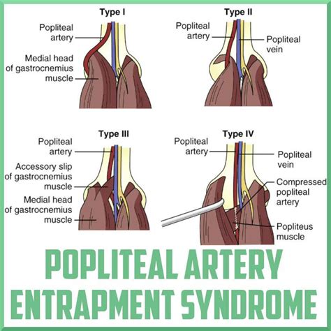 Popliteal Artery Entrapment Syndrome
