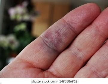Popped Vessel In Finger