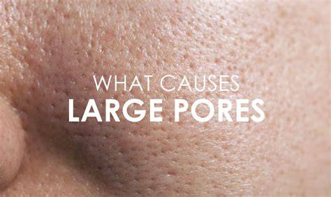 Pores On Face