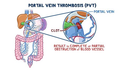 Portal Vein Thrombosis
