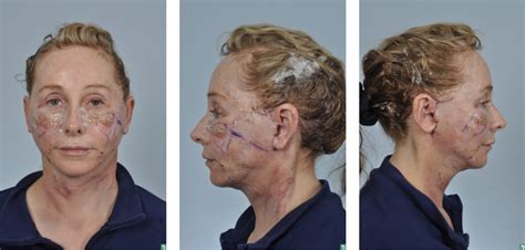 Post Face Lift Surgery