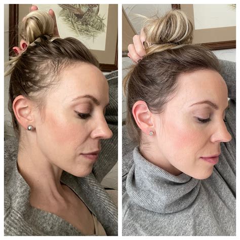 Post Pregnancy Hair Loss