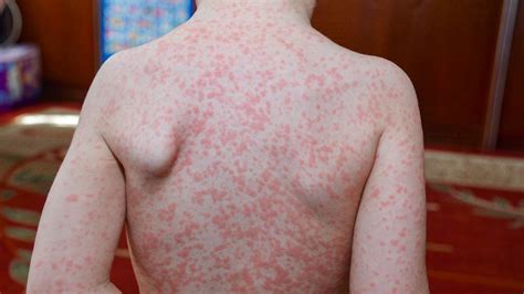 Post Viral Rash