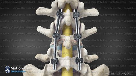 Posterior Spinal Fusion