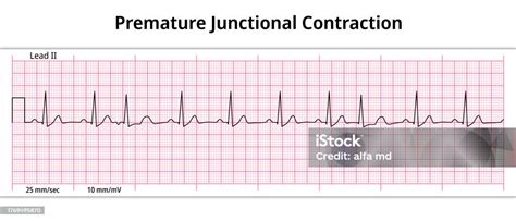Premature Junctional Contraction