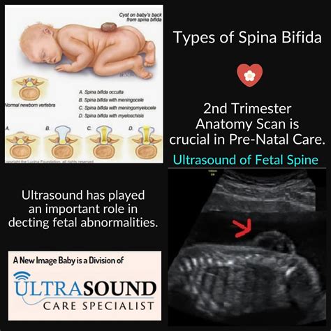 Prenatal Screening Spina Bifida