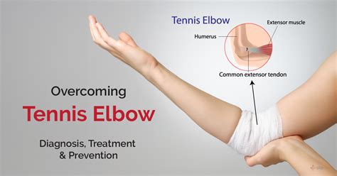 Prevention For Tennis Elbow