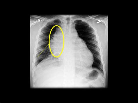 Primary Mediastinal B Cell Lymphoma