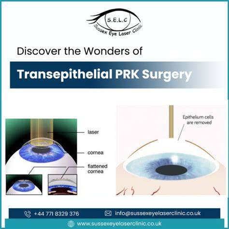 Prk Eye Surgery